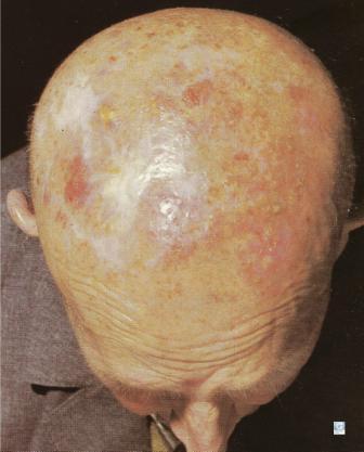 Kératose Actinique sur le scalp