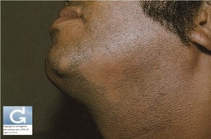 Alopecia Areata (beard area)