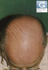Androgenetic Alopecia (or common balding) stage VI (according to the classification of Hamilton)