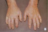 Chronic contact eczema (dermatitis) of the hands