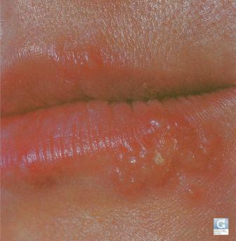 Herpes de la lèvre (bouton de fièvre)