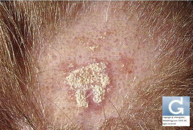 Global Dermatology » Maladies inflammatoires de peau sur le cuir ...