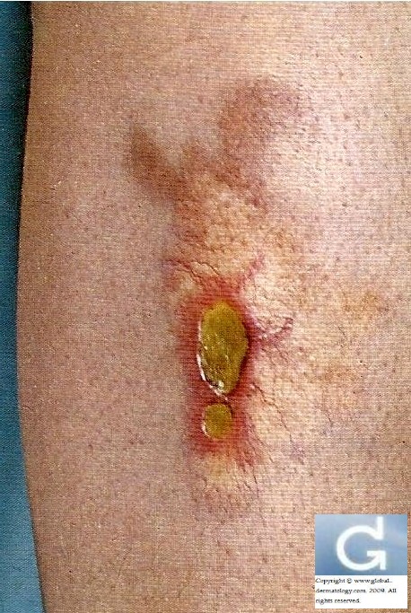 Necrobiosis Lipoidica Treatment