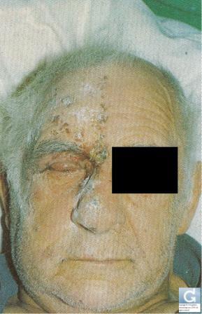 Shingles on the face