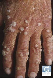 Multiples Viral Warts located on the Hands