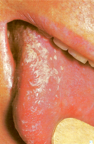 Global Dermatology » Troubles de la peau sur les lèvres et dans la ...