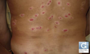 Psoriasis responsive to excimer laser treatment