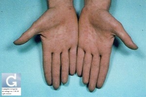 Secondary Syphilis located on the Palms
