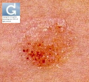 Eczema pruriginoso - Psoriasis meaning in marathi language