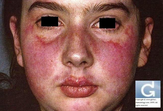 Why Is It Butterfly Rash Develop In Systemic Lupus Erythematosus