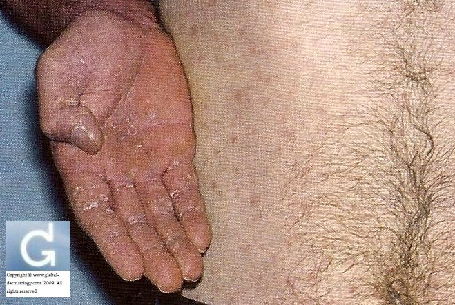 pityriasis rosea rash pictures #10
