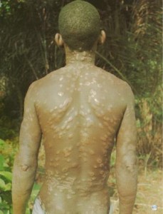 Borderline Leprosy (Hansen's disease) 