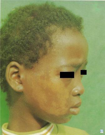 Tuberculoid Leprosy (Hansen's