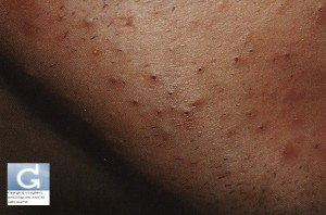 Lésions de l'acné rétentionnelle: comédons ouverts et fermés (points blancs et points noirs)