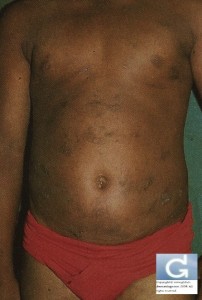A hiperpigmentação pós-inflamatória (após um eczema)