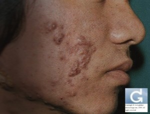 Severe inflammatory acne vulgaris with nodules and cysts (Nodulocystic)