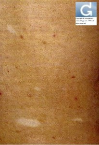 Sclérose Tubéreuse de Bourneville: aspect en feuille de sorbier