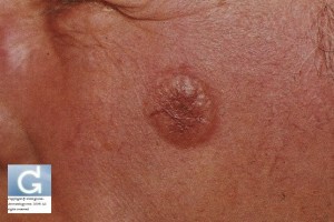 Carcinome Basocellulaire sur le joue