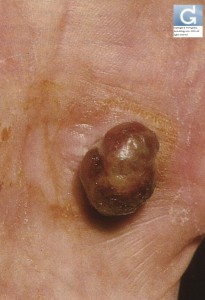 Pyogenic Granuloma (Lobular Capillary Hemangioma)