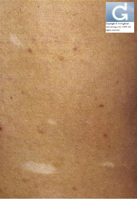 Nevus Anemicus Clinical Presentation: History, Physical ...