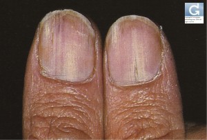 Stries longitudinales des ongles (maladie de Darier)