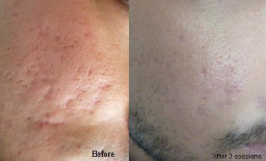 Acne scars microneedling: before and after
