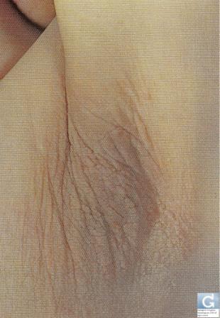 Acanthosis Nigricans 