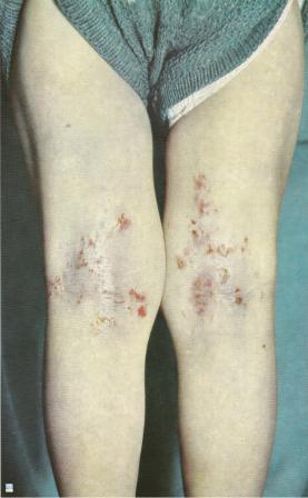 Dermatite atopique 