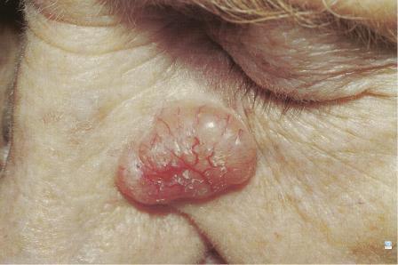 Carcinome Basocellulaire situé au niveau du visage