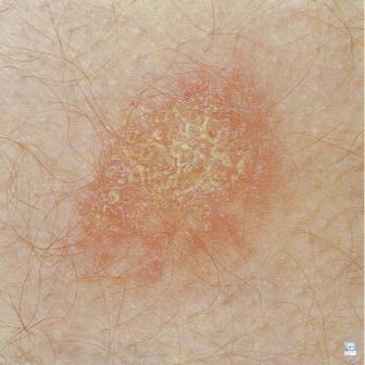 Nummular or discoid eczema