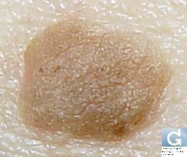 Seborrhoeic keratosis