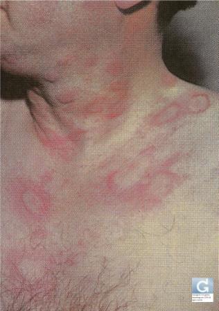 Urticaria