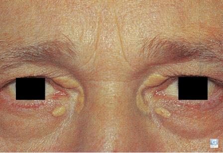 Xanthelasma