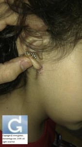 Contact dermatitis to earrings containing nickel
