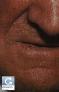 Squamous Cell Carcinoma presenting as a small ulceration on the lower lip