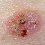 Aspect after rubbing of a seborrhoeic keratosis