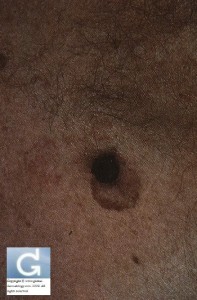 Melanoma: identifiable when using the ABCDE rule