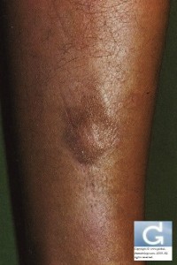 Post-Inflammatory Hyperpigmentation following Lichen Planus