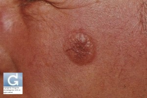 Basal Cell Carcinoma on the cheek