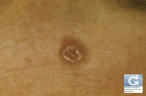 Basal Cell Carcinoma on the forehead