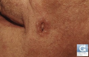 Basal Cell Carcinoma presenting as a non healing wound