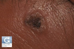 Pigmented Basal Cell Carcinoma in an Asian Patient